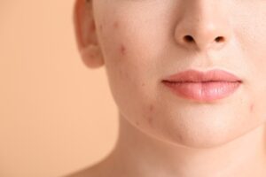 woman, peach background, acne